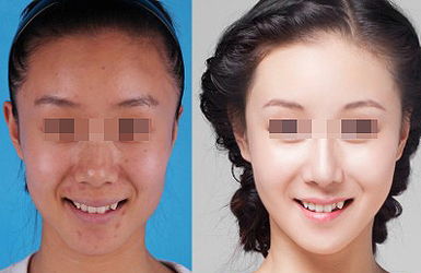 皮秒治療做完后要多久見(jiàn)效？